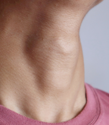 A man's neck are abnormal showing the enlargement of thyroid gland.